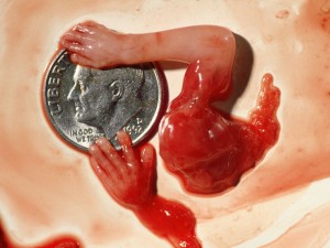 Abortion at 10 weeks Abortion at 10 weeks